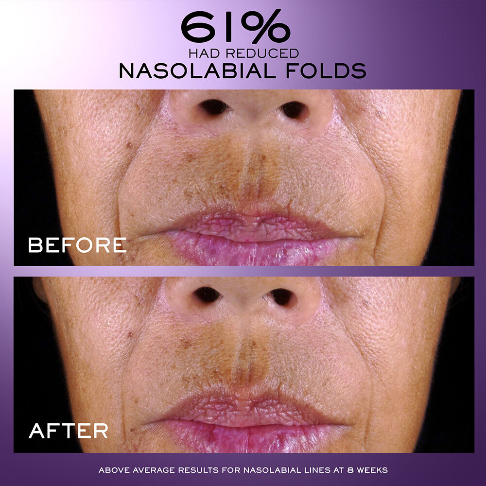 61% had reduced nasolabial folds, before and after to show average results for nasolabial lines at 8 weeks 