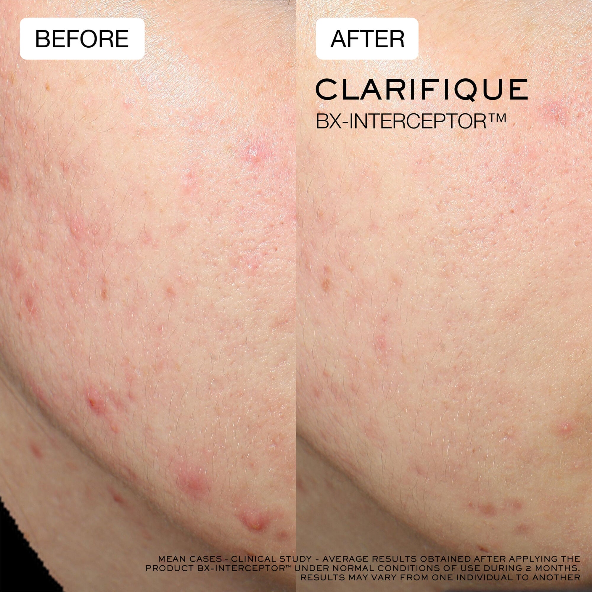 Average results on jaw from clinical study, before and after using Clarifique Bx-Interceptor for 2 months 
