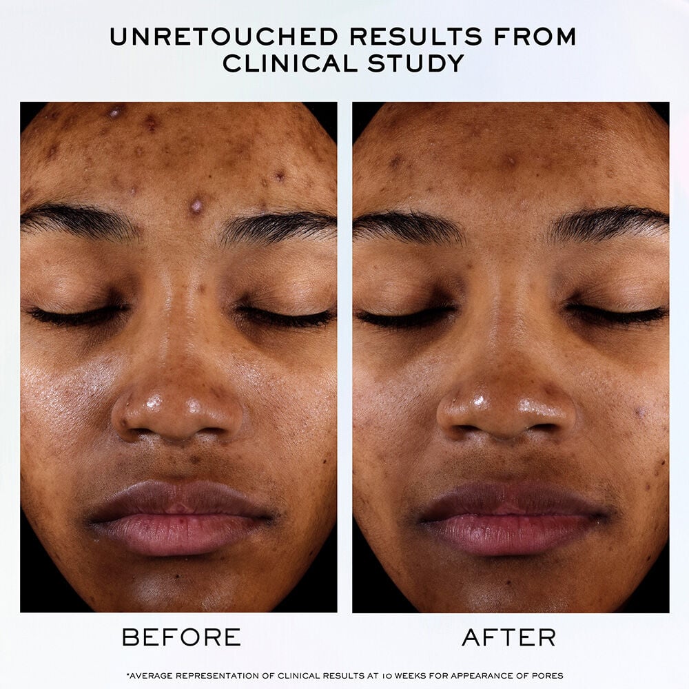Unretouched results from clinical study before & after 10 weeks of use, average representation of appearance of pores 