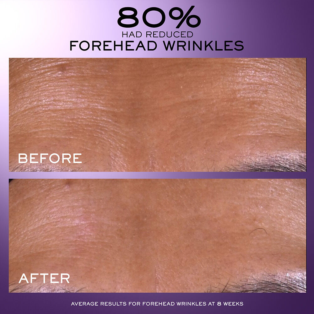 80% had reduced forehead wrinkles, before and after to show average results for forehead wrinkles at 8 weeks 