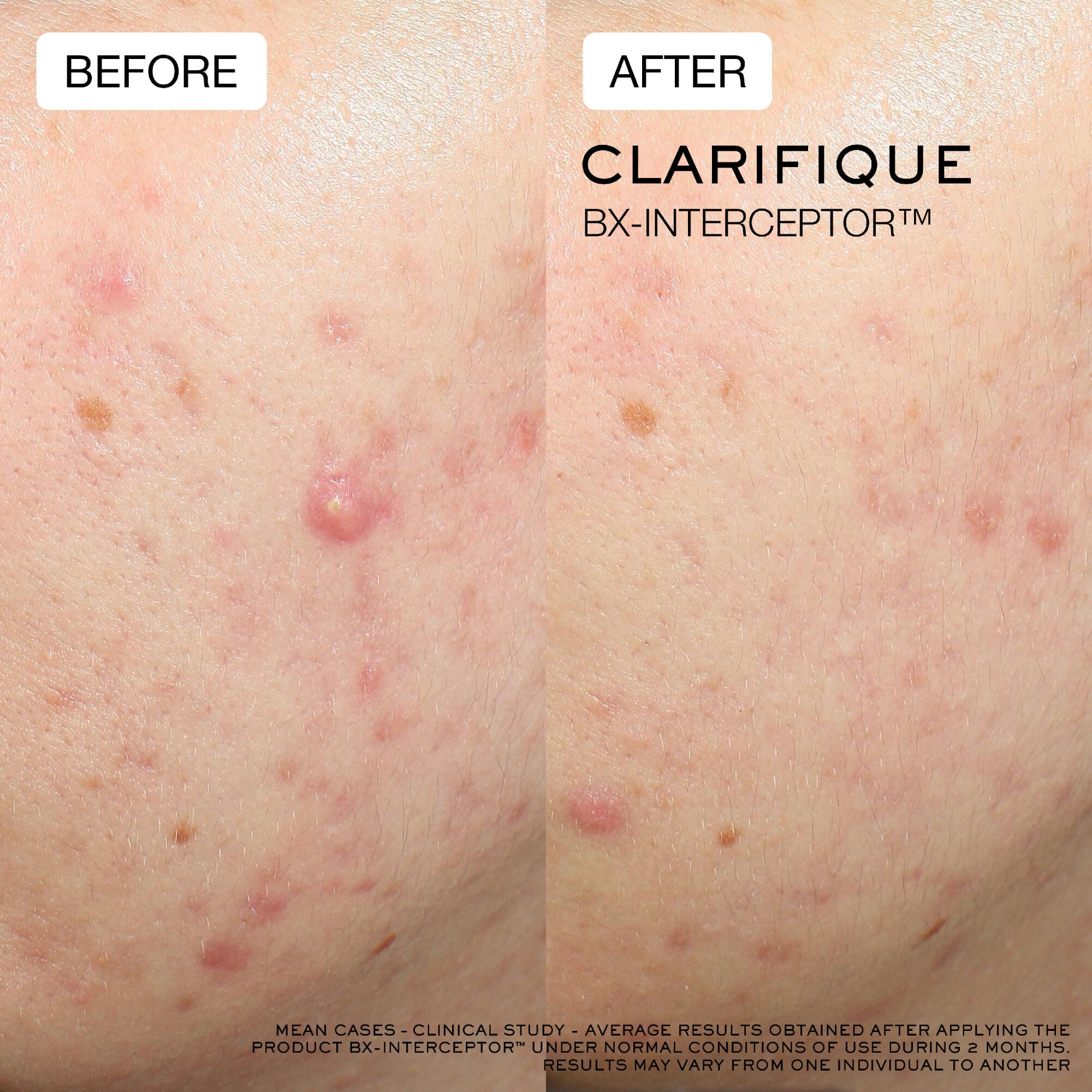 Average results on cheek from clinical study, before and after using Clarifique Bx-Interceptor for 2 months 