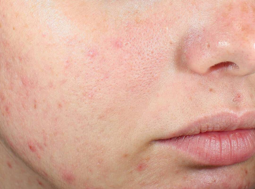Clarifique Bx-Interceptor™️ Medicated Acne Treatment - Lancôme
